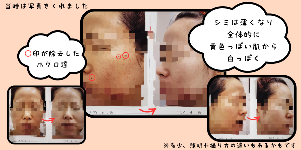 クリニックで撮影された顔写真の比較。左がH28年6月16日、右がH29年4月13日。「当時は写真をくれました」「○印が除去したホクロ達」「シミは薄くなり全体的に黄色っぽい肌から白っぽく」「※多少、照明や撮り方の違いもあるかもです」と書き添えてある（顔はモザイク加工）