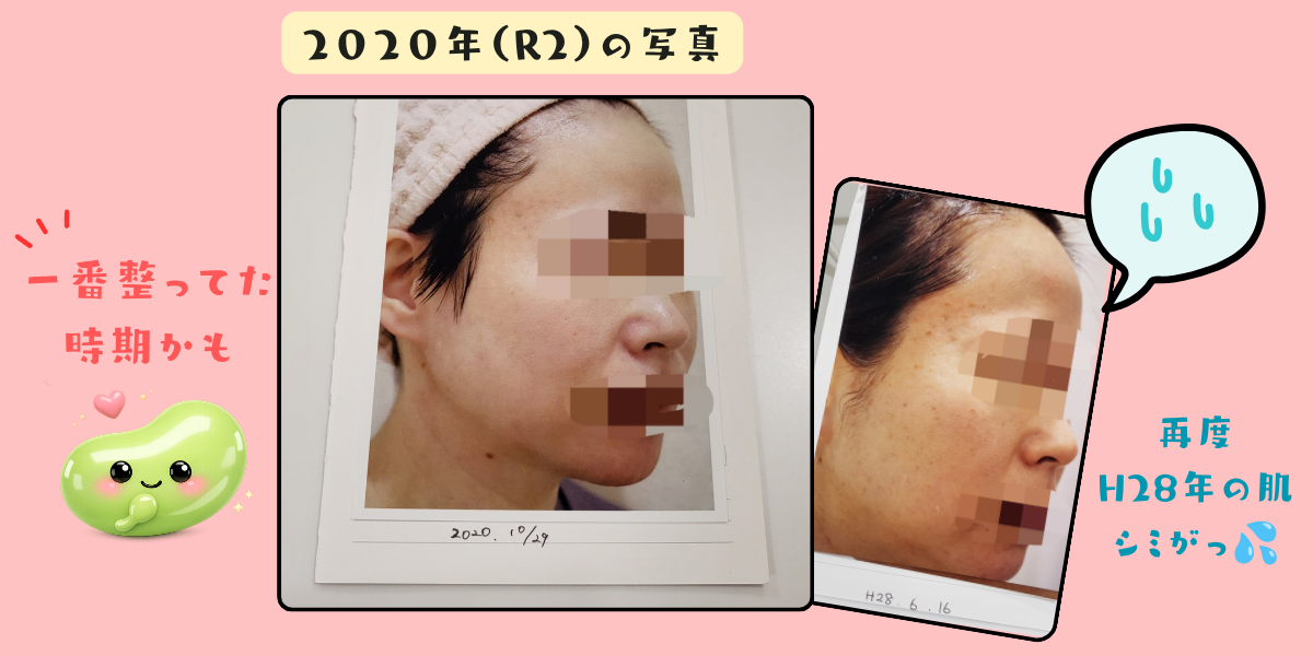 2020年10月29日に撮影された顔写真と、H28年6月16日の写真の比較。「2020年（R2）の写真」「一番整ってた時期かも」「再度H28年の肌 シミがっ」と豆実のイラスト付きで書き添えてある（顔はモザイク加工）
